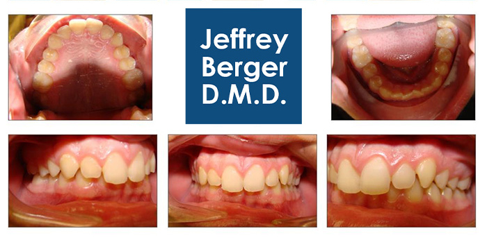 Before Treatment