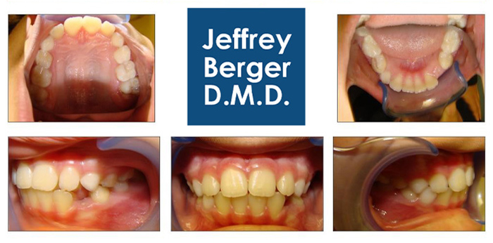Before Treatment